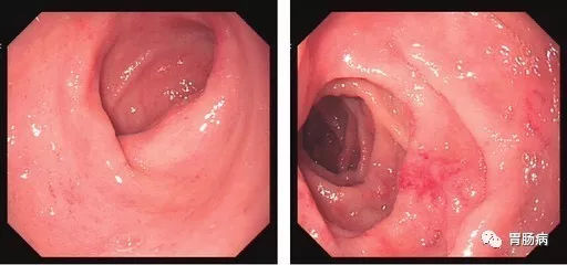 萎縮性胃炎不可怕，只要真正了解它