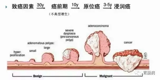 體檢查出腸息肉一定要切除！ 95%腸癌由它演變而來